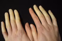 Ngón tay trắng bệch đầy kỳ lạ vào mùa lạnh, đừng chủ quan