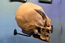 Phát hiện hộp sọ “người ngoài hành tinh” dị thường gắn kim loại