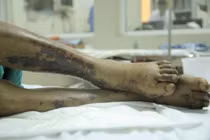 Một phụ nữ nhiễm liên cầu lợn: Bệnh nguy hiểm ra sao?