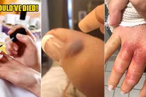 Suýt mất mạng vì nhiễm virus ăn thịt khi đi làm móng tay 