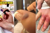 Suýt mất mạng vì nhiễm virus ăn thịt khi đi làm móng tay 
