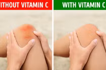 Những dấu hiệu cảnh báo cơ thể đang thiếu hụt vitamin C