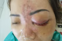 Kinh hoàng những vụ spa không phép tiêm filler gây biến chứng, tàn phế suốt đời
