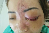 Kinh hoàng những vụ spa không phép tiêm filler gây biến chứng, tàn phế suốt đời