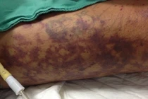 Viêm màng não do liên cầu khuẩn lợn: Chọn thịt lợn thế nào để tránh mắc bệnh?