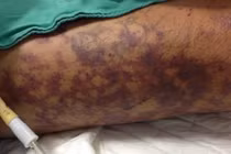 Viêm màng não do liên cầu khuẩn lợn: Chọn thịt lợn thế nào để tránh mắc bệnh?