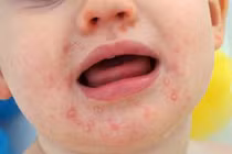 Nhiều trẻ mắc tay chân miệng thể nặng: Chữa thế nào tránh biến chứng?