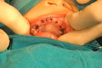 Mẹ sai lầm đáng trách, bé 4 tuổi phải "khoét" bỏ 20 răng bị thối