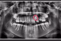 Bé 12 tuổi bị u răng: Triệu chứng, điều trị, dinh dưỡng phù hợp?