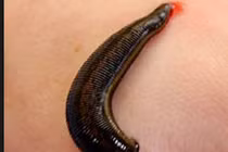 Xanh mặt những trường hợp đỉa cắn màng trinh, vùng kín "lòi" vật lạ 30cm