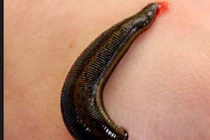 Xanh mặt những trường hợp đỉa cắn màng trinh, vùng kín "lòi" vật lạ 30cm