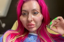 Người mẫu có cặp má lồi lõm kinh dị vì nghiện tiêm filler