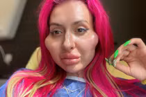 Người mẫu có cặp má lồi lõm kinh dị vì nghiện tiêm filler