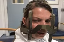 Đi khám đau đầu không ngờ phát hiện 16 khối u ác tính trong não