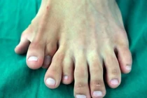 Hy hữu chàng trai có 9 ngón trên một bàn chân