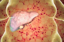 Bé trai mới 8 tuổi bị gan nhiễm mỡ: Cách phòng bệnh cho trẻ em