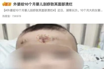 Bà ngoại cạo gió chữa ho, bé gái 10 tháng nhập viện cấp cứu