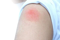 Sau tiêm vắc xin COVID-19, nên làm gì để giảm đau vết sưng?