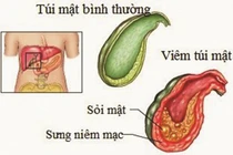 Nguyên nhân bé 9 tuổi đã bị sỏi mật khiến bố mẹ hết hồn