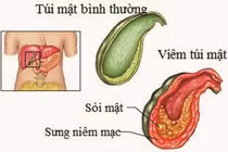 Nguyên nhân bé 9 tuổi đã bị sỏi mật khiến bố mẹ hết hồn