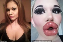 Kinh dị hình ảnh đôi môi dày nhất thế giới của cô gái bơm môi 20 lần