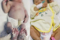 Bé sơ sinh ở Nghệ An mắc bệnh giang mai 