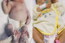 Bé sơ sinh ở Nghệ An mắc bệnh giang mai 