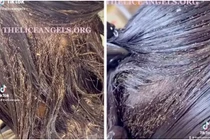 Sốc với cảnh tượng chấy bò lúc nhúc trên đầu bé gái