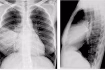 Phi công người Anh mắc COVID-19 bị đông đặc 1 bên phổi: Nguy hiểm thế nào?