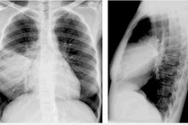 Phi công người Anh mắc COVID-19 bị đông đặc 1 bên phổi: Nguy hiểm thế nào?