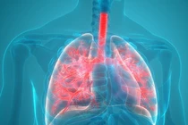 Nam sinh lớp 10 tử vong vì lao ruột: Bệnh nguy hiểm ra sao?