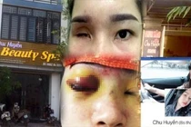 Spa Chu Huyền nói gì khi làm mù mắt cô gái trẻ tiêm filler nâng mũi?