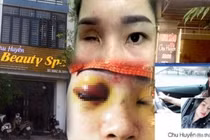 Spa Chu Huyền nói gì khi làm mù mắt cô gái trẻ tiêm filler nâng mũi?