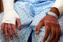 Đổ xăng đốt cháy người ở Nghệ An: Nguyên tắc sống còn khi bị bỏng xăng