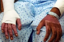 Đổ xăng đốt cháy người ở Nghệ An: Nguyên tắc sống còn khi bị bỏng xăng