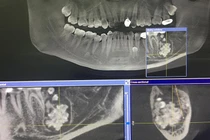 Thanh niên mọc răng lúc nhúc dưới lợi: Khối u răng nguy hiểm sao?