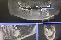 Thanh niên mọc răng lúc nhúc dưới lợi: Khối u răng nguy hiểm sao?