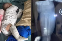 Malaysia: Phát hiện con bị gãy chân sau 2 tuần gửi người trông trẻ