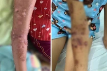 Bé gái bị bỏng nặng vì sứa “cắn”: Cách sơ cứu đúng cần biết