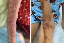 Bé gái bị bỏng nặng vì sứa “cắn”: Cách sơ cứu đúng cần biết