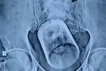 Người đàn ông khiến bác sĩ sốc vì... chiếc cốc trong trực tràng