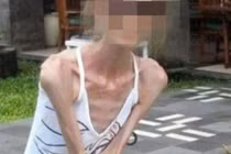 Ăn kiêng cực đoan, người phụ nữ “da bọc xương” chỉ nặng 25kg