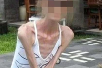 Ăn kiêng cực đoan, người phụ nữ “da bọc xương” chỉ nặng 25kg