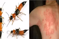 Nọc độc kiến ba khoang nguy hại đến mức nào, dấu hiệu cần đi viện?