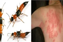 Nọc độc kiến ba khoang nguy hại đến mức nào, dấu hiệu cần đi viện?