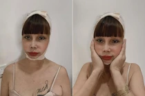 Gương mặt biến dạng kinh hoàng vì “dao kéo” của cô dâu 62 tuổi