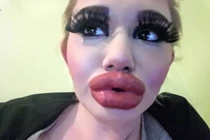 Tiêm 17 lần để có môi “khủng” nhất: Kỷ lục chưa thấy, hại thân thế nào?