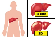 Chứng đầy hơi có thể là dấu hiệu 6 căn bệnh nguy hiểm cần cảnh giác
