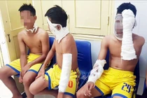 Nổ bóng bay 4 người bỏng nặng: Cẩn trọng khi trẻ chơi bóng này 