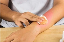 Hồng Ngọc bị bỏng nặng mặt, ngực: Làm thế nào chữa nhanh, xoá sẹo hiệu quả?